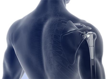 Artificial Intelligence Enhances Shoulder Arthroplasty