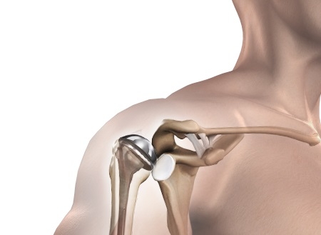 New Published Study: Innovative Products Create Value for Shoulder Arthroplasty Patients